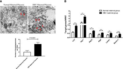 The Role of Autophagy in the Mother-to-Child Transmission of Pregnant Women With a High Level of HBV DNA